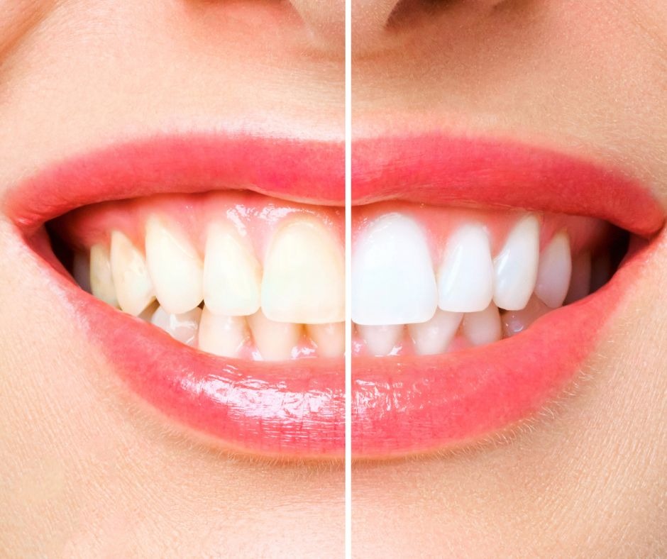 Close-up of a smiling mouth split in half, showing a comparison. Left side displays yellowed teeth; right side shows teeth whitened, radiant and bright.