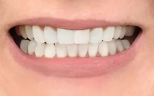 A perfect smile of white teeth