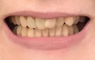A smile with crocked yellow teeth